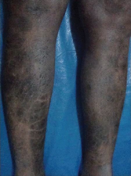 Persistent Eczematous Lesions Over The Body Bhat Rm Pinto Hp Kini Rg