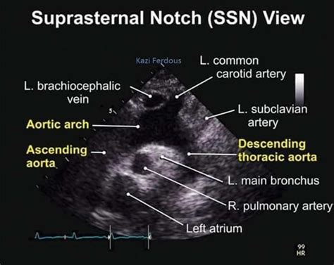 Suprasternal Notch View Tee Diagnostic Medical Sonography Cardiac