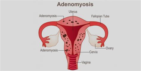 Adenomyosis Symptoms Causes And Treatment OnlyMyHealth