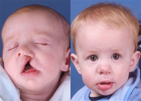 Cleft Lip Surgery Before After Gallery James P Bradley Md
