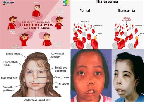 Mengenal Jenis Thalassemia Dan Perbedaannya Dengan Hemoglobinopati My