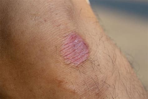 Cdc Highly Contagious Drug Resistant Ringworm Reported In Us For