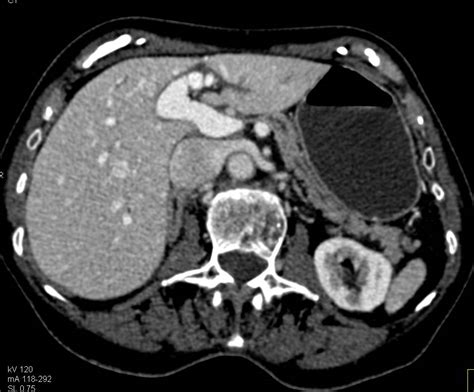 Atrophic Pancreas Pancreas Case Studies Ctisus Ct Scanning