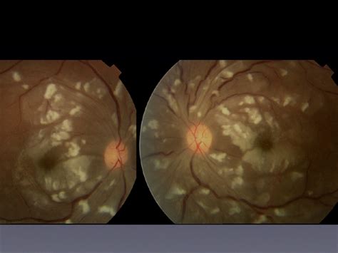 Retinal Vasculopathy With Retinal Vasculitis And Ischemia Retina