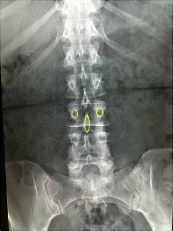 Case contributed by assoc prof craig hacking ◉ ◈. Lumbar X-rays: A systematic approach | Neurosurgery Basics