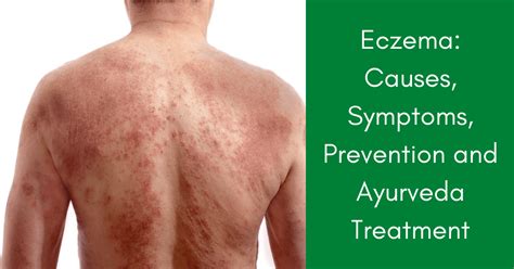 Eczema Treatment Symptoms Ayurveda Theayurveda