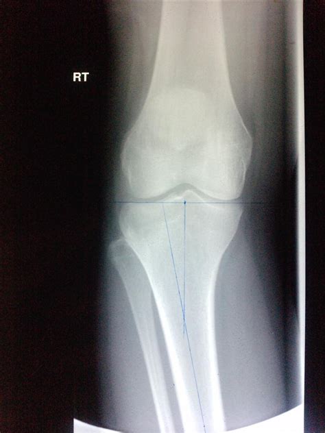Genu Valgum Knocked Knees Pediatrics Orthobullets