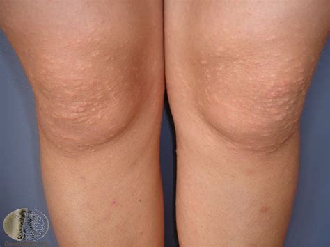 Bumps Behind Knees Atopic Dermatitis Symptoms