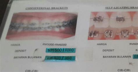 Perubahan yang dibawa oleh klx 2020. Pengalaman Pakai Braces A.K.A Pendakap Gigi Di Dr Faiz ...