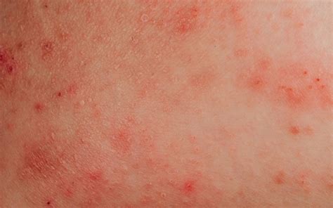 What Triggers Eczema And How To Avoid It