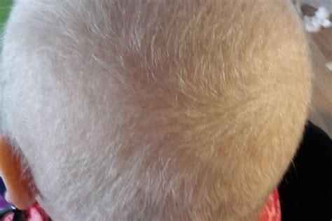 Haarausfall Durch Chemotherapie Alopecia Medicamentosa THYMUSKIN