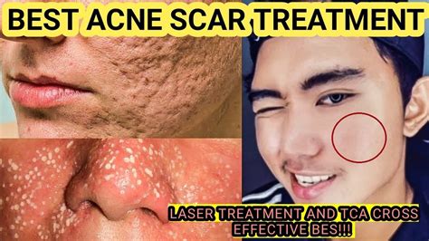 Laser Acne Scar Treatment Maganda Ba And Effective Solution How To Treat
