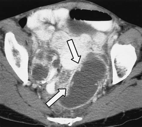 Spectrum Of Ct Findings In Acute Pyogenic Pelvic Inflammatory Disease