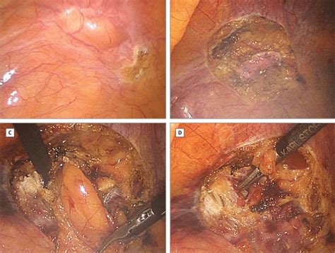 Incisional hernia is one of the most common postoperative complications after abdominal surgery. Photographs of the Technique of Laparoscopic Ventral Hernia Repair A B | Download Scientific Diagram