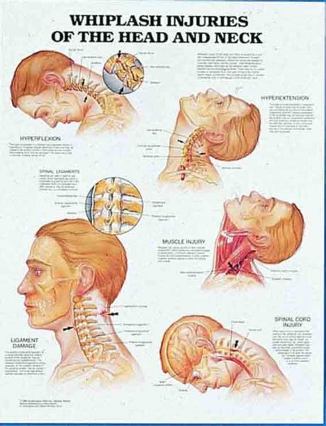 Anatomy And Injuries Of Head And Neck Chart 20x26 Nec
