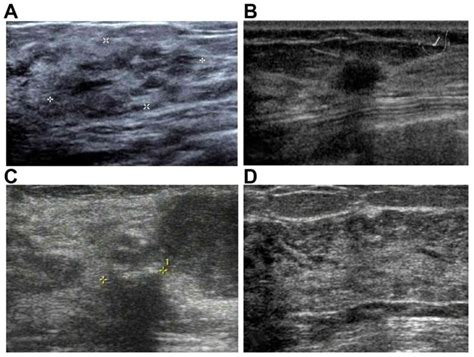 Sclerosing Adenosis Ultrasonographic And Mammographic Findings And