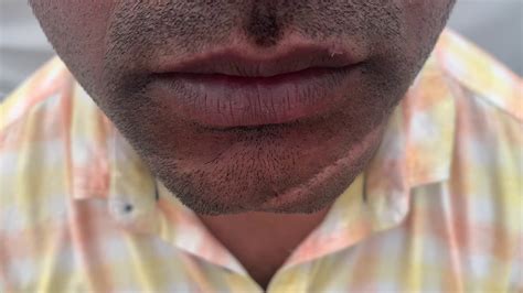 Giant Chin Scar Revision Surgical Video Facial Post Traumatic