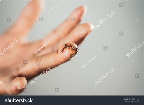 Close Man Hand Sutured Wound On Stock Photo 1972971140 Shutterstock