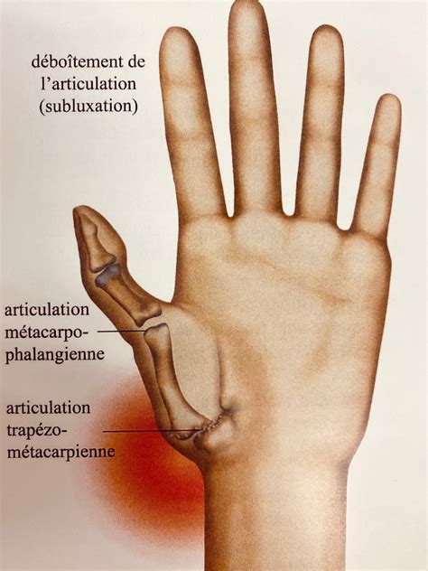 Rhizarthrose Larthrose Du Pouce Elsan