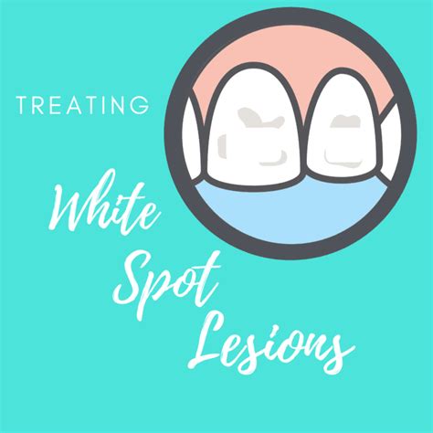 Treating White Spot Lesions