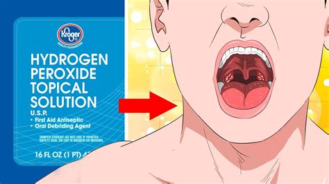 Canker sores are commonly mistaken for cold sores, but the two conditions are very different. 10 Surprising Uses For Hydrogen Peroxide YOU NEED TO KNOW ...