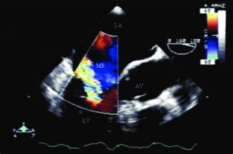 Transesophageal Echocardiogram Color Doppler Demonstration Of Severe
