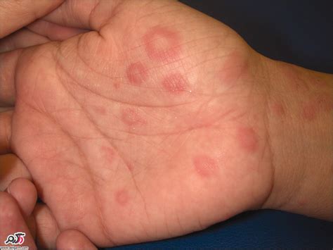 What Is This Rash On My Hands And Feet