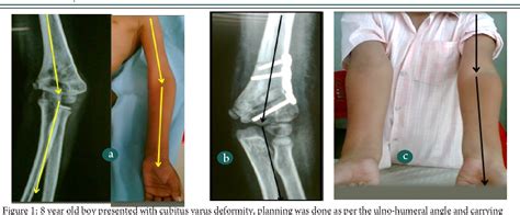 Figure 1 From Cubitus Varus Deformity Rationale Of Treatment And