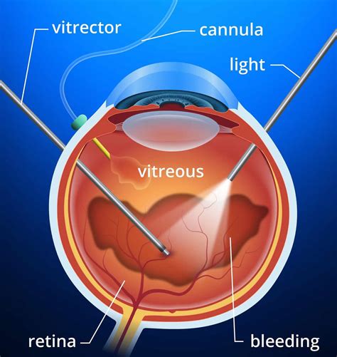 Incidence and characterization of retinal detachments after macular hole repair. Vitrectomy surgery indications, risks & vitrectomy ...