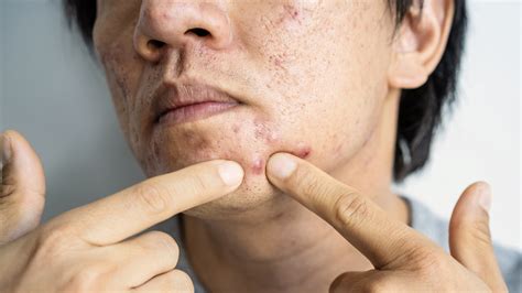 How To Treat Different Types Of Acne Scars