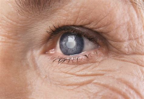 Cataracts And Blindness Can Vision Loss Be Reversed Eye Care