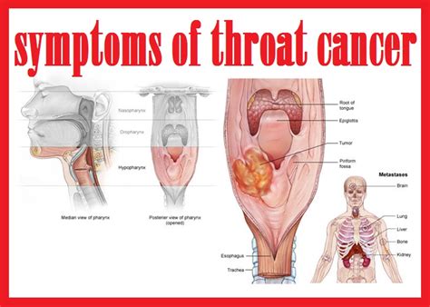 Doctors stage throat cancer as stage i, ii, iii, or iv. Head And Neck Cancer - Signs Of Throat Cancer | Kimaja ...
