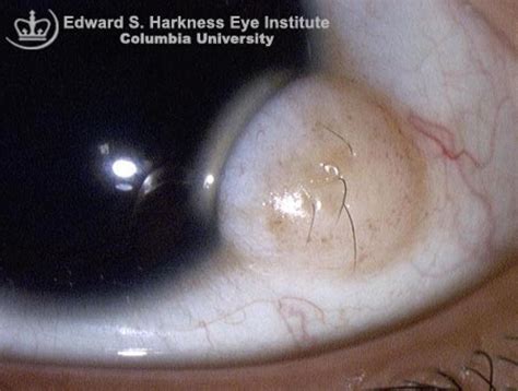 Limbal Dermoid Vagelos College Of Physicians And Surgeons