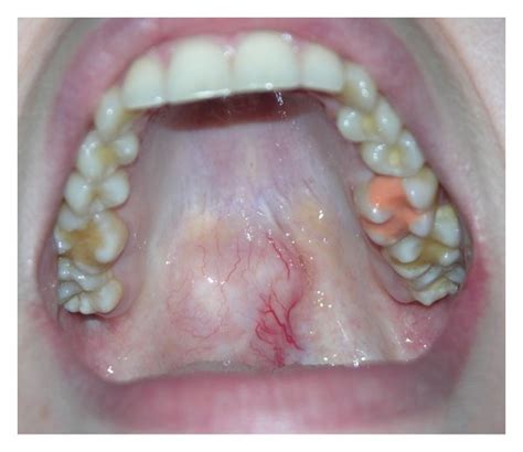 Oral Cancer Soft Palate