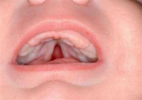 Cleft Palate Boise Boise Idaho Cleft And Craniofacial Institute