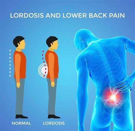 Lordosis And Lower Back Pain