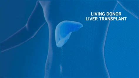 Living Donor Liver Transplant Cleveland Clinic Florida Youtube