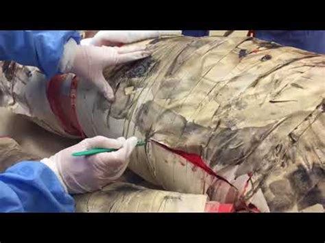 Looking for online definition of escharotomy in the medical dictionary? Escharotomy on JumPic.com