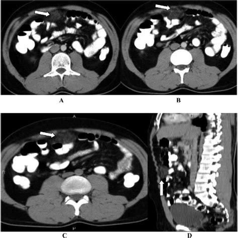 Ct Scan Abdomen Axial Aandb And Cmpr Candd Showing Cystic Mucocele Due