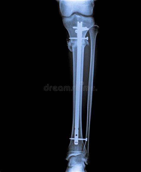 Fracture Tibia With Implant Stock Image Image Of Health Fracture