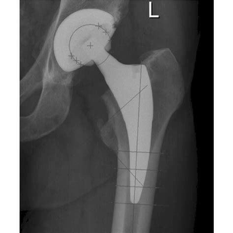 Figure Of An Anteroposterior Radiograph Of The Hip After Implantation