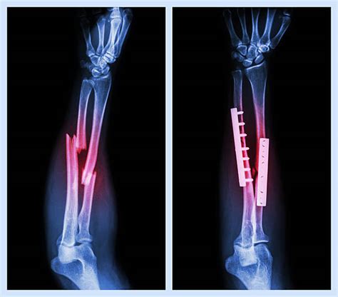 Best Arm X Ray Stock Photos Pictures And Royalty Free Images Istock