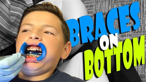 getting bottom braces eriktv365 day 2289 youtube