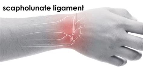 Scapholunate Ligament Physio Plus