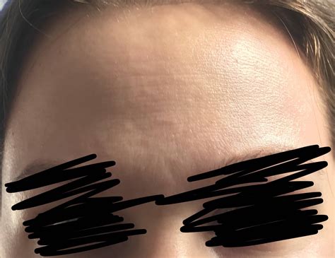 Skin Concerns Forehead Lines Normal Or Dehydration Skincareaddiction
