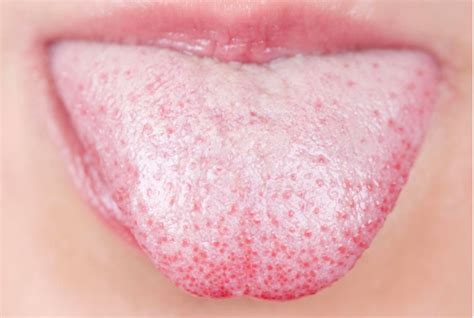You may observe a white spot on the tongue after experiencing discomfort or when checking inside your mouth after brushing your teeth. THIS is what a white tongue says about your health! Very ...