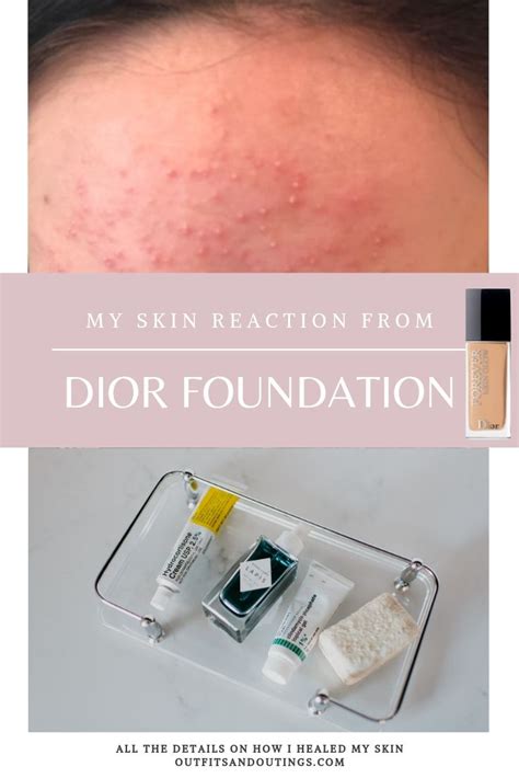 Dior Forever Foundation Allergic Reaction Beauty Outfits And Outings