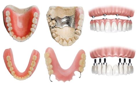 What Is The Best Denture Type For You Direct Denture Care Denture Clinic