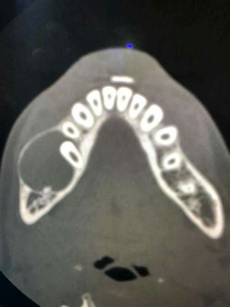 Dentigerous Cyst Diagnostic Imaging Bone Diseases Radiology