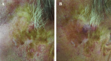 A Discoid Lupus Erythematosus Dle Scar On The Left Temporal Region